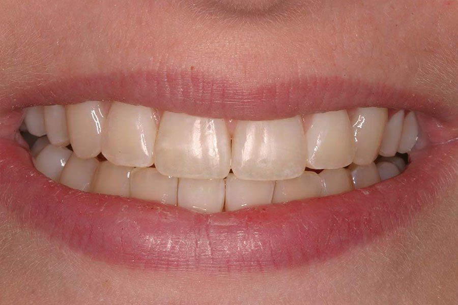 Dental Fillings Before