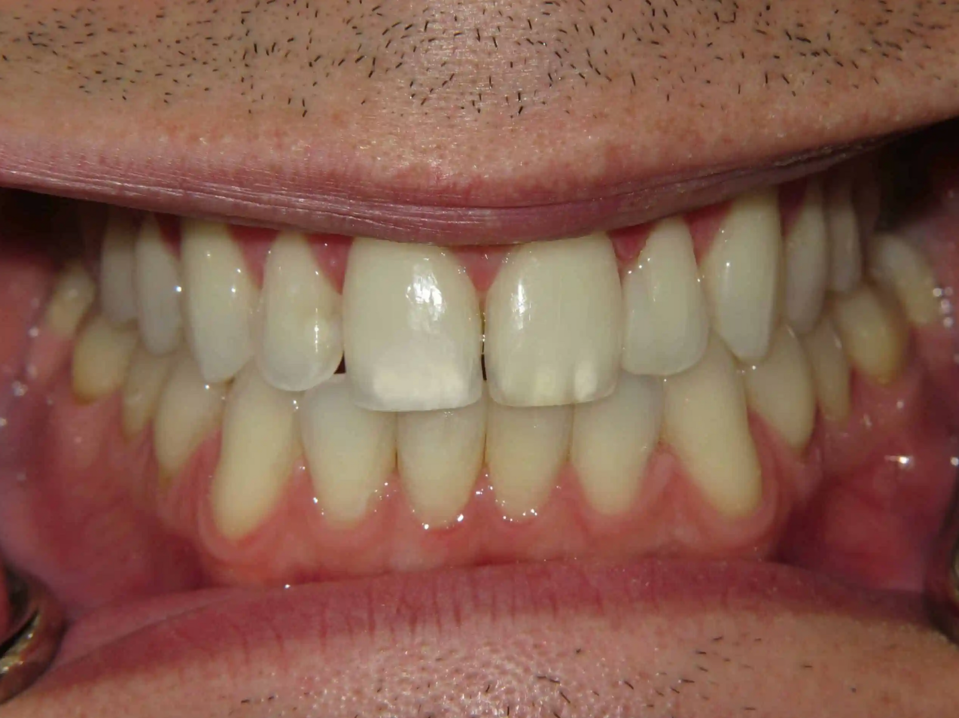 A close up of a man 's mouth with white teeth.