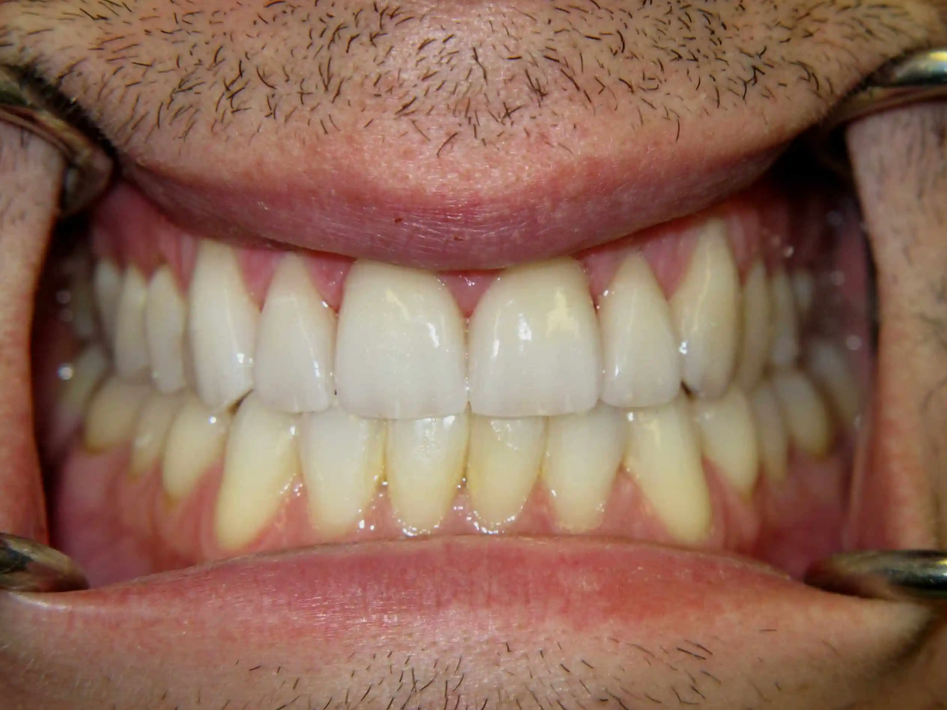A close up of a man 's teeth with a beard.