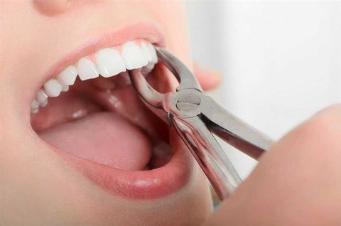 A woman is getting her teeth removed by a dentist.