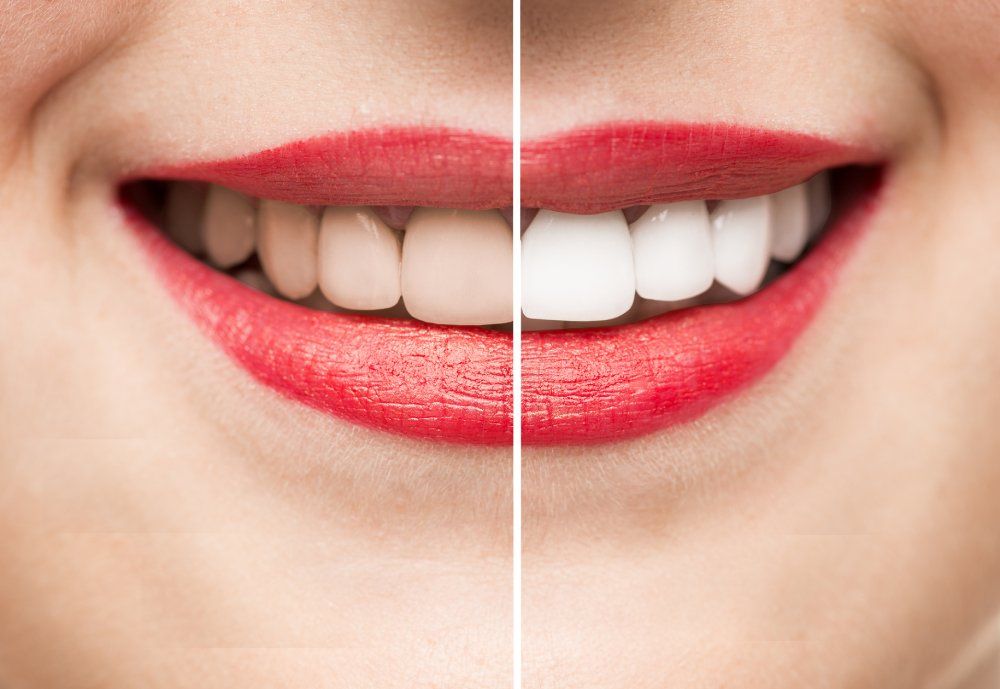 Sbiancamento denti prima e dopo