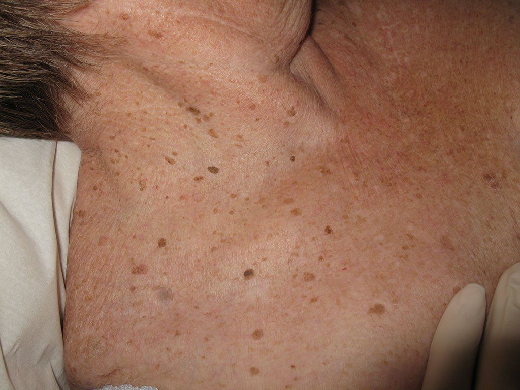 black spots on skin