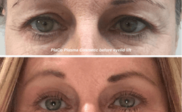 result of eye treatment