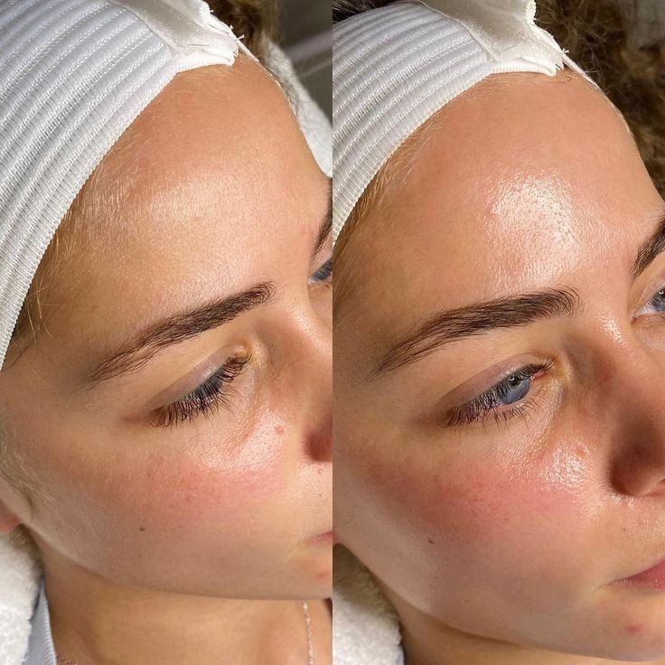 dermaplaning before and after