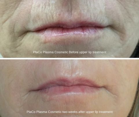 result of plasma treatment on upper lips