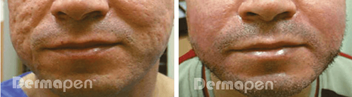 Dermapen treatment before and after