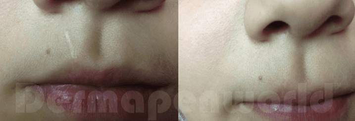 Derma Pen-Skin needling on lips
