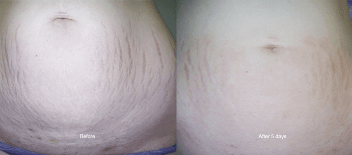 Scar removal from stomach