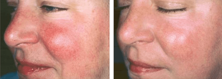 reduction of redness on cheeks