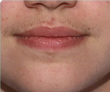 hair around lips