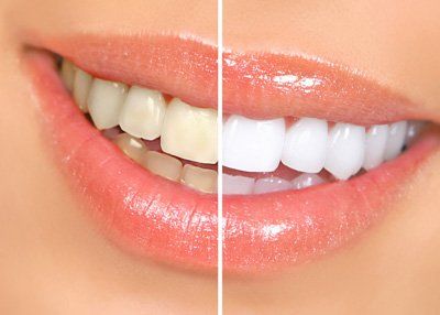 before and after result of teeth whitening
