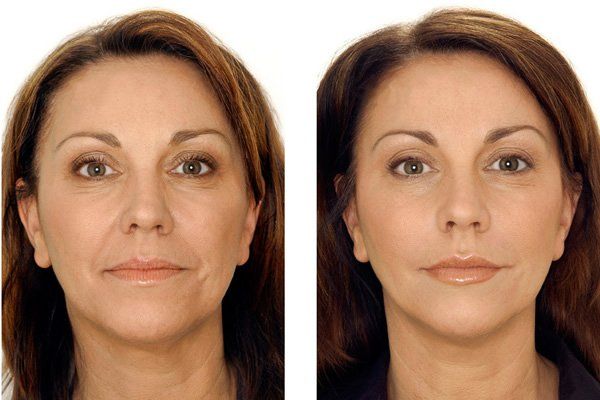 anti wrinkles treatment done on face