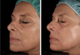 facial skin treatment