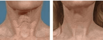 skin treatment  around neck
