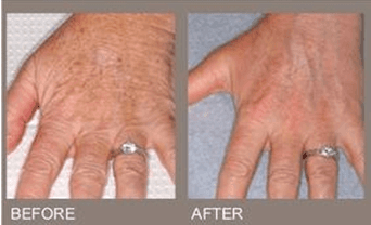 skin treatment on hand