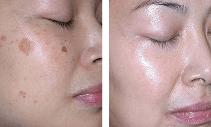 facial Pigmentation treatment