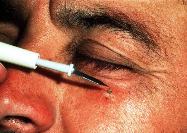 Benign Lesion removal under eye