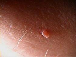 Benign Lesion removal