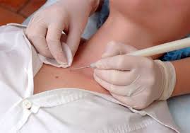 Benign Lesion removal on hips