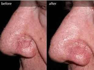 Red Vein Removal on nose