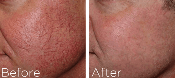 Red Vein Removal on cheeks
