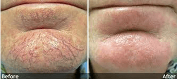 Red Vein Removal on chin