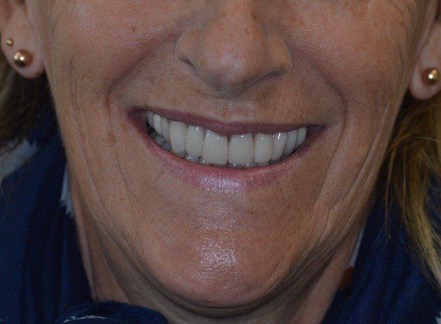After dental veneer procedure