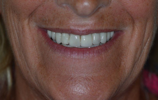 After dental veneer procedure