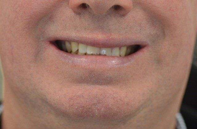 Before dental veneer procedure
