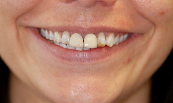 Before teeth whitening treatment