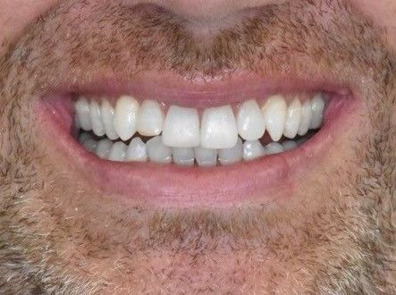 After teeth whitening treatment