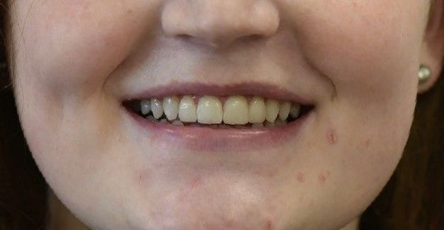 After teeth whitening treatment