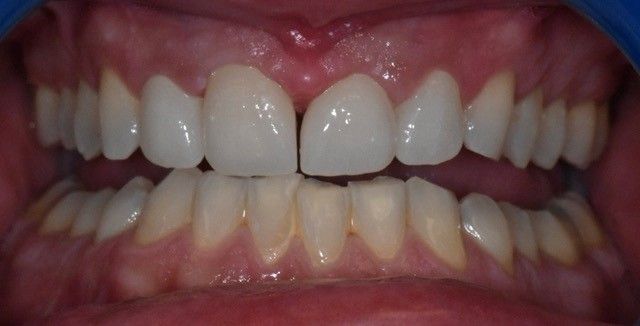 After teeth whitening treatment