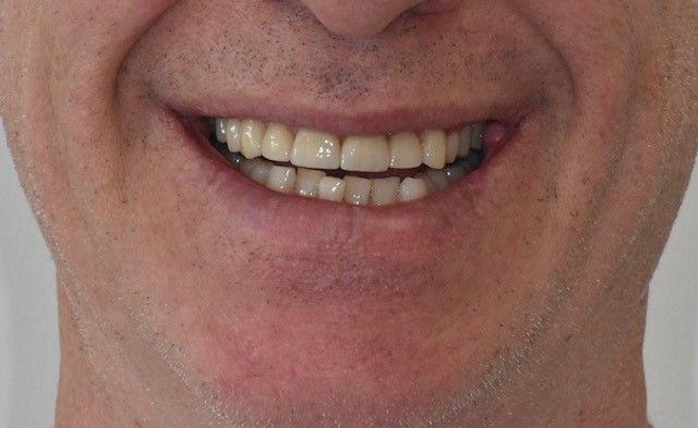 After teeth whitening treatment