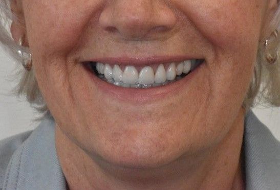 After teeth whitening treatment