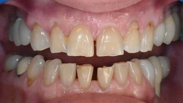 Before teeth whitening treatment