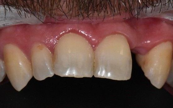 Before teeth whitening treatment