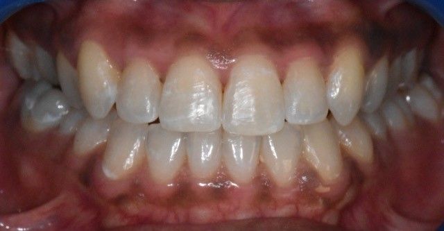 After Invisalign braces