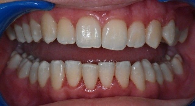 After Invisalign braces