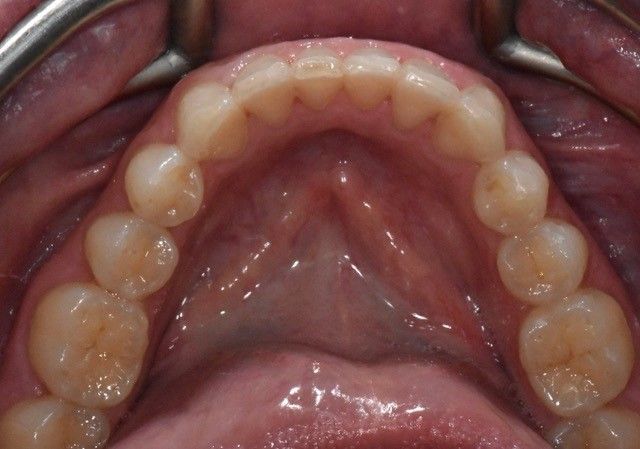 After Invisalign braces