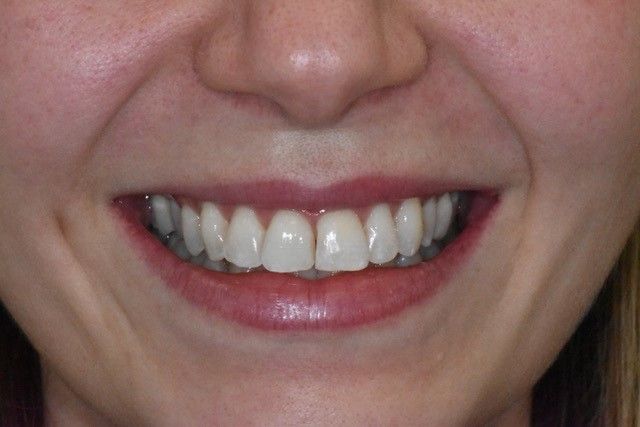 After Invisalign braces