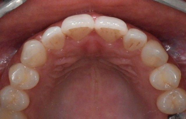 After Invisalign braces