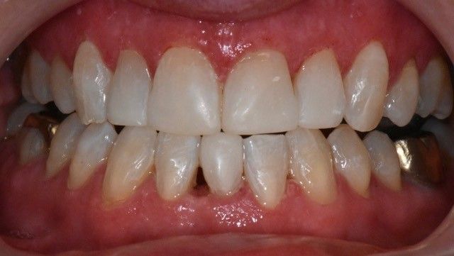 After Invisalign braces