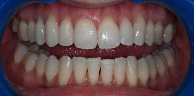 After Invisalign braces