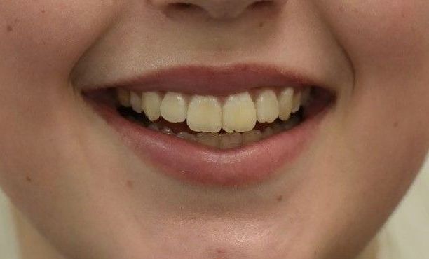 After Invisalign braces