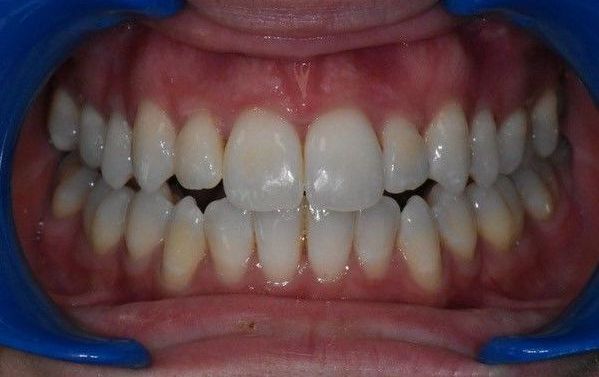 After Invisalign braces