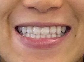 After Invisalign braces