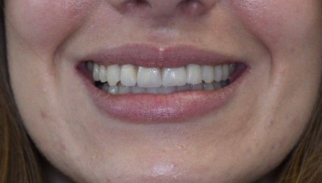 After Invisalign braces