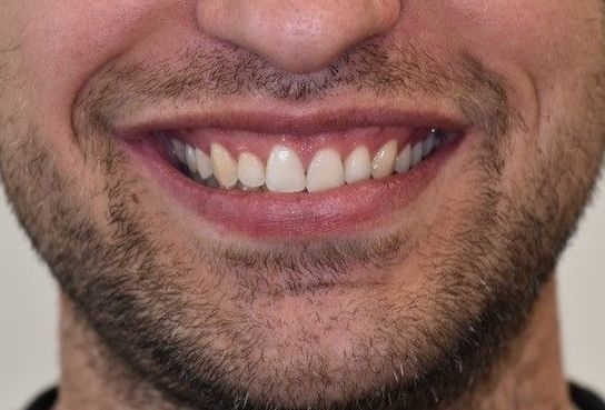 After Invisalign braces