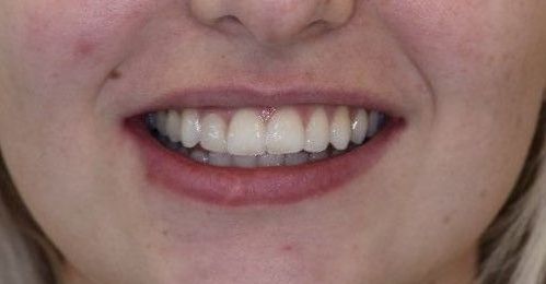 After Invisalign braces